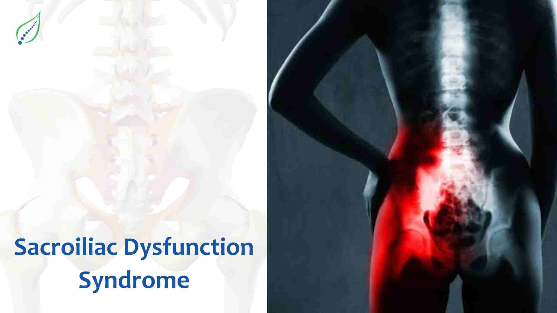 Sacroiliac Dysfunction Syndrome – Causes, Symptoms & Treatment